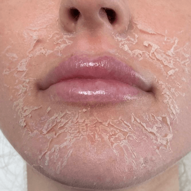 Glow & Go Reviver - Chemical Peels